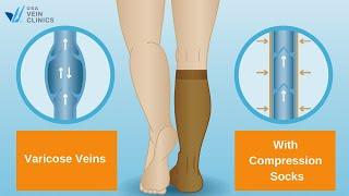 The Benefits of Vein  Compression Socks