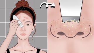 Skin Care Animation丨Pimple popping丨Acne treatment丨Meng's Stop Motion
