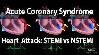 Acute Coronary Syndrome: Unstable Angina, NSTEMI and STEMI (Heart Attack), Animation