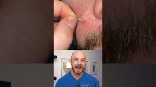 Derm reacts to perfect pimple patch removal! #satisfying #pimplepatch #dermreacts #doctorreacts