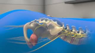 Neuspera Sacral Neuromodulation System for Urinary Urgency Incontinence (UUI) - 3D animation