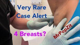 Very RARE case alert! 4 breasts? Accessory breast tissue development along embryologic milk lines.