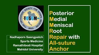 Posterior medial meniscal root repair with all suture anchor