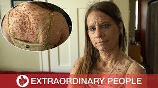 Skin Condition Leaves Woman with Nearly 6,000 Tumors