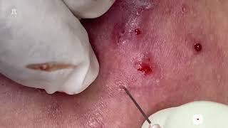 Big Cystic Acne Blackheads Extraction Blackheads & Milia, Whiteheads Removal Pimple Popping