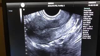 Transvaginal Ultrasound