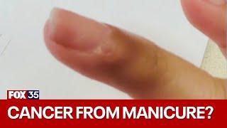 Doctor says manicure gave woman cancer under her fingernail