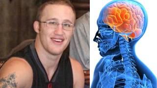 UFC Fighters with the worst brain damage