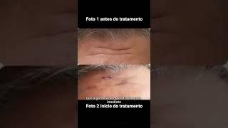 tratamento de rugas estáticas na testa. botox fios preenchimento com ácido hialurônico.