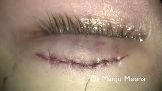 Asian Blepharoplasty- Incisional Method by Dr Manju Meena