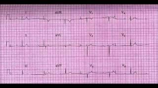 ЭКГ номер 12 - заключение, клиническая интерпретация и что делать
