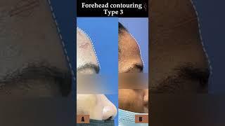 Forehead Contouring Type 3 | #foreheadcontouring #facialfeminizationsurgery #Shorts #youtubeshorts