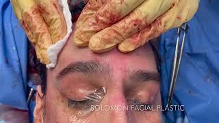 Facial Feminization Surgery | Brow Bone Reduction | Solomon Facial Plastic