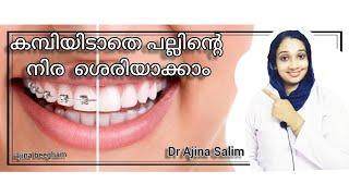 How to correct teeth without braces | Dental aligners| clear aligners|Dr Ajina Salim