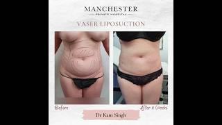 Vaser Liposuction Before and After Results by Dr Kam Singh