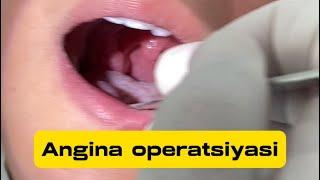 Angina operatsiyasi