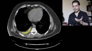 Pericardial fat pad vs pericardial effusion