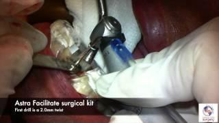 Immediate Implant and Provisional #8 Using GALILEOS Guided Surgery