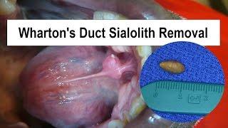 Wharton's Duct Sialolith Removal