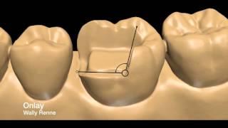 Posterior tooth preparations inlay, onlay, crownlay and crown