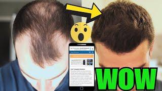 These Results Are EPIC- Hair Restoration Network