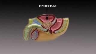 Лечение рака предстательной железы (простаты). Брахитерапия в Израиле