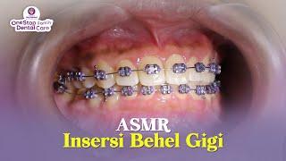 ASMR INSERSI BEHEL GIGI ( PEMASANGAN BEHEL GIGI )