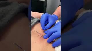 Low Back Dry Needling