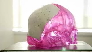 3D Modeling for Surgical Prep | Virtual Surgical Planning at Penn Medicine