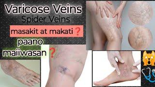 Varicose Veins at Spider Veins. mayron kaba nito? masakit at makati? Paano maiiwasan?