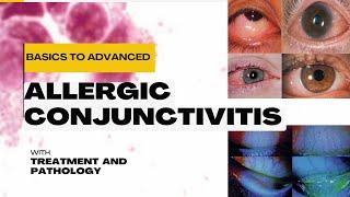 Allergic Conjunctivitis: Classification, Pathophysiology, Treatment & Management Explained