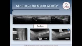 Ultrasound for bone fractures