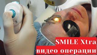 ReLEx SMILE Xtra (СМАЙЛ Экстра) - лазерная коррекция зрения СМАЙЛ и кросслинкинг - видео операции