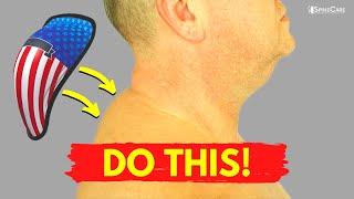 How to Fix a Neck Hump With an Athletic Cup