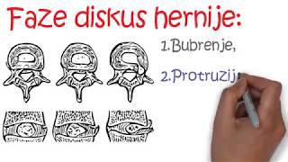 DISKUS HERNIJA