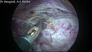 Skeletonisation at Uterine Isthmus