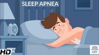 Sleep Apnea, Causes,Signs and Symptoms, DIagnosis and Treatment.