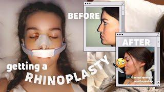 getting a nose job *vlog*