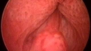 world premiere – male orgasm (ejaculation) filmed through an endoscope