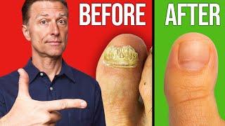 The Fastest Way to Get Rid of Toenail Fungus