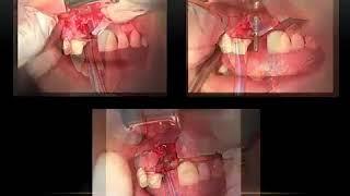 Dental Implants Case Study - MSDI implants