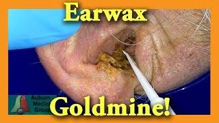 Earwax GOLDMINE | Auburn Medical Group