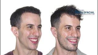 Double jaw surgery Case # 82: Daniel- Biretrusion, long face