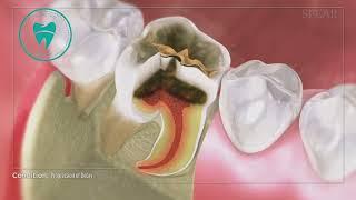 Tooth Decay - Proactive Dentist