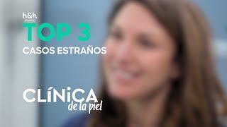 Top 3 Casos Extraños | Clínica de la piel | Discovery H&H