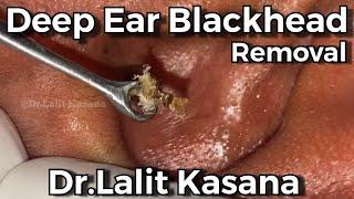 Deep Old Ear Blackhead Removal Full Video by Dr.Lalit Kasana