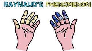 RAYNAUDS SYNDROME | CAUSE, APPEARANCE, DIAGNOSIS AND TREATMENT - RAYNAUDS PHENOMENON