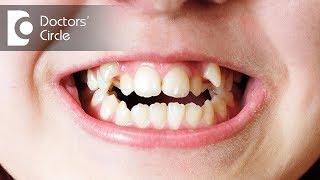 Types of Malocclusion - Dr. Manissha Agarwal