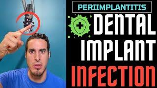 If you wear DENTAL IMPLANTS you should WATCH THIS - Dental Implant INFECTION or PERIIMPLANTITIS