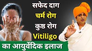 सफेद दाग, चर्म रोग, कुष्ठ रोग, Vitiligo का आयुर्वेदिक इलाज || Sanyasi Ayurveda ||